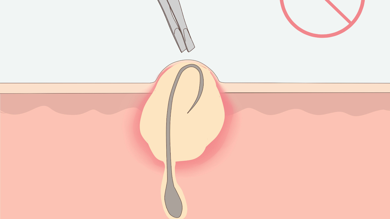 Lông mọc ngược xoắn vào trong gây ra mụn mủ hoặc mụn viêm 