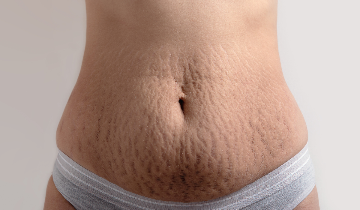 Một ví dụ rạn da sau sinh ở vùng bụng 