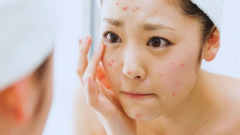 Dùng kem chống nắng bị nổi mụn do nhiều nguyên nhân gây ra